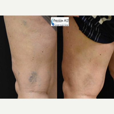 Sclerotherapy before and after photo
