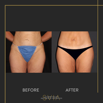 Body Lift before and after photo