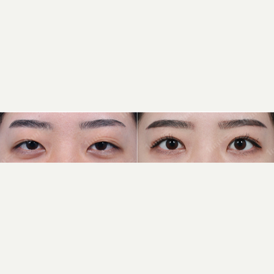 Eyelid Surgery before and after photo