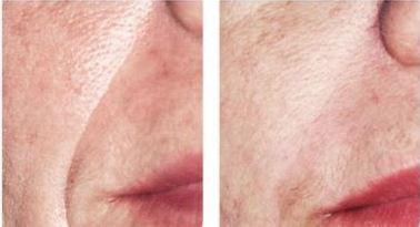 ArteFill before and after photo