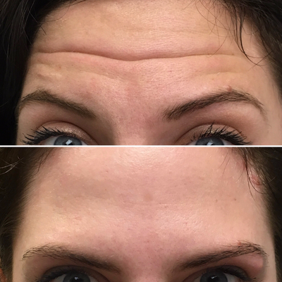 Botox before and after photo