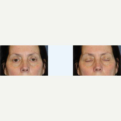 Eyelid Surgery before and after photo