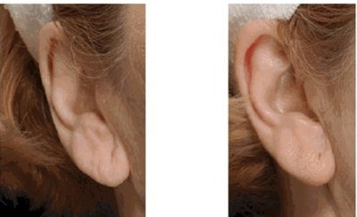 Restylane before and after photo