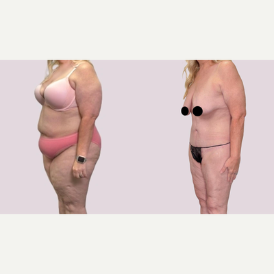 Drainless Tummy Tuck before and after photo