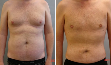 Gynecomastia Surgery before and after photo
