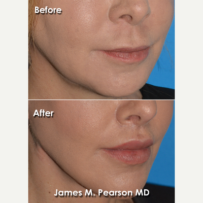 Lip Lift before and after photo