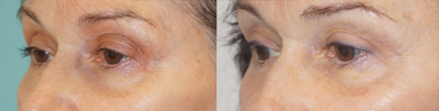 Eyelid Surgery before and after photo