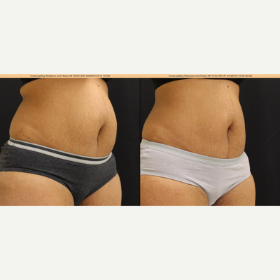 CoolSculpting before and after photo