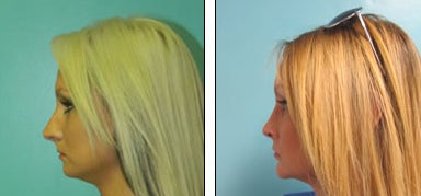 Rhinoplasty before and after photo