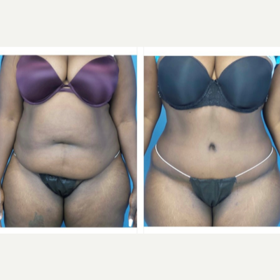 Tummy Tuck before and after photo