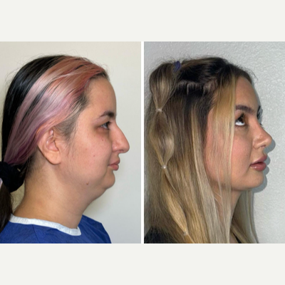 Rhinoplasty before and after photo