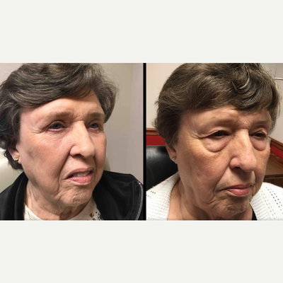 Laser Resurfacing before and after photo