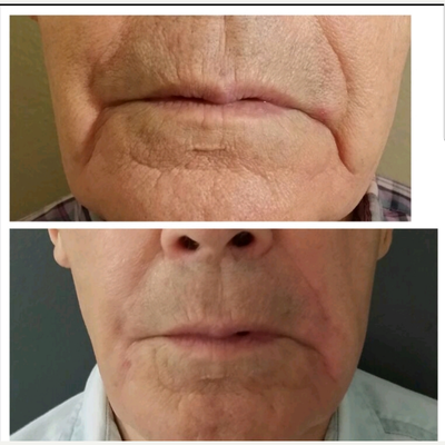 Dermal Fillers before and after photo