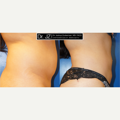 Liposuction before and after photo