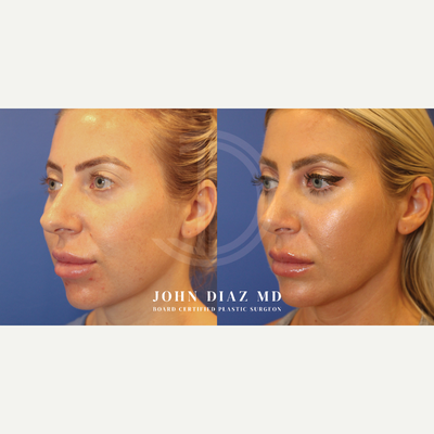 Rhinoplasty before and after photo