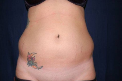 Considering Liposuction? Here's What You Need to Know: Rafael C