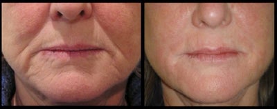 Restylane before and after photo