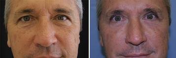 Eyelid Surgery before and after photo