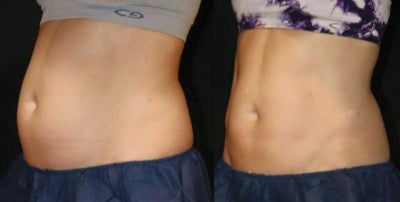 CoolSculpting before and after photo