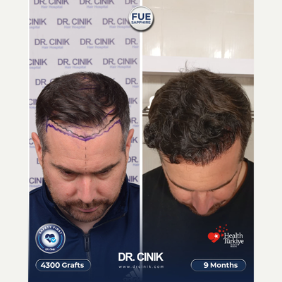 FUE Hair Transplant before and after photo