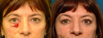 Facial Reconstructive Surgery before and after photo