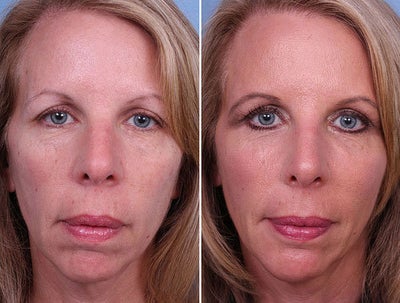 Radiesse before and after photo