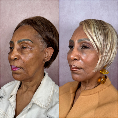 Eyelid Surgery before and after photo