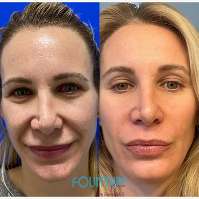 CO2 Laser before and after photo