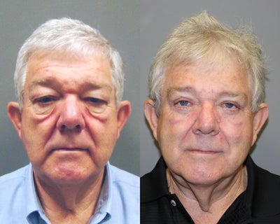 Eyelid Surgery before and after photo