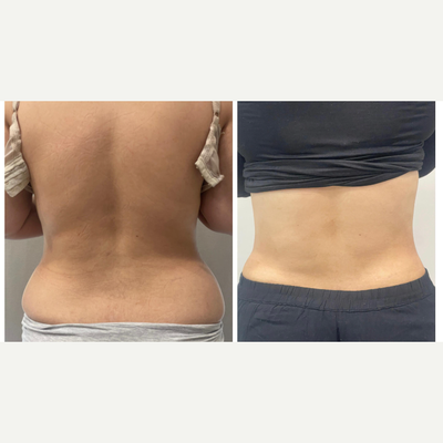 Tummy Tuck before and after photo