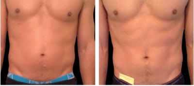 Emsculpt before and after photo