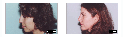 Facelift before and after photo