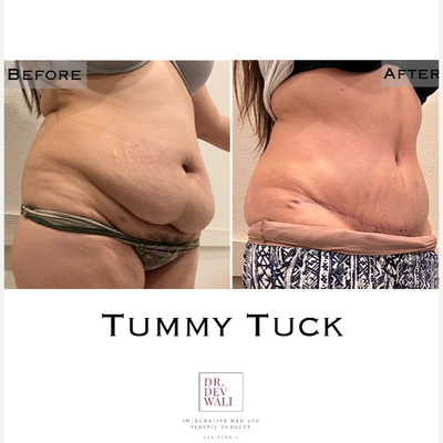 Tummy Tuck before and after photo