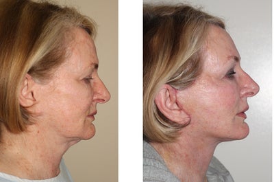Facelift before and after photo
