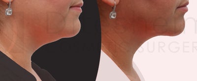 Body-Jet Liposuction before and after photo