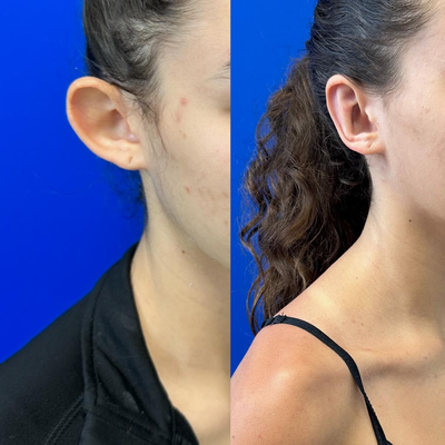 Ear Surgery before and after photo