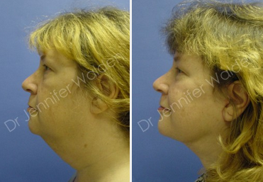 Facelift before and after photo