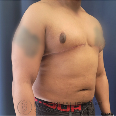 https://fi.realself.com/full/3/c/d/Gynecomastia-Surgery-after-13095691-5937609.png