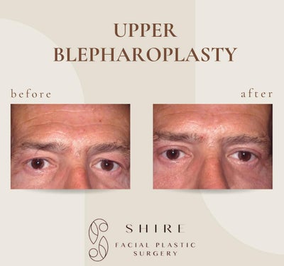 Eyelid Surgery before and after photo