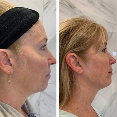 Dermal Fillers before and after photo