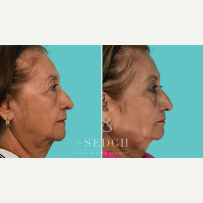 Eyelid Surgery before and after photo
