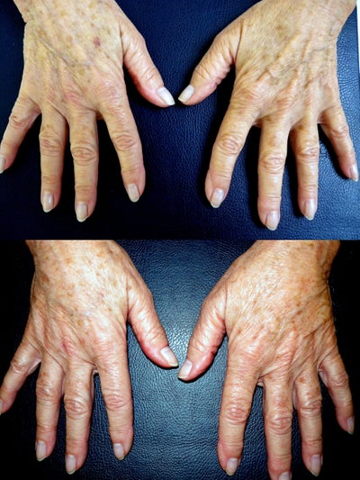 Radiesse before and after photo