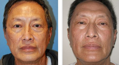 Chemical Peel before and after photo