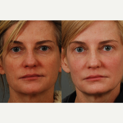 Dermal Fillers before and after photo