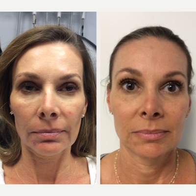 PRP Injections before and after photo