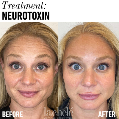 Botox before and after photo