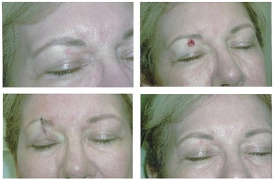 Mohs Surgery before and after photo