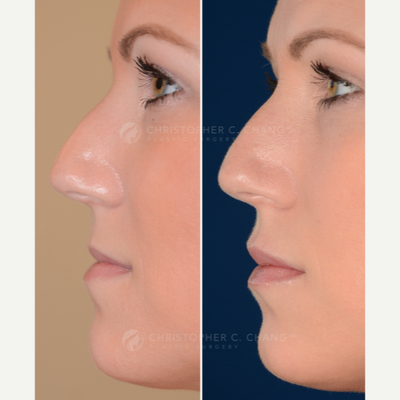 Lip Fillers before and after photo