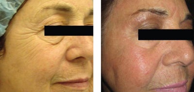 Botox before and after photo