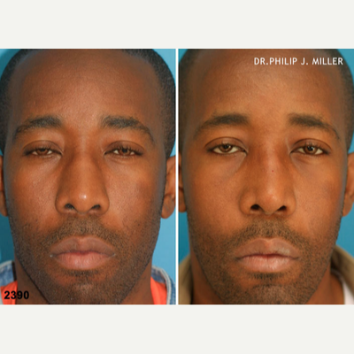African American Rhinoplasty before and after photo